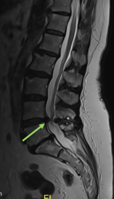 Spinalkanalstenose-sagittal