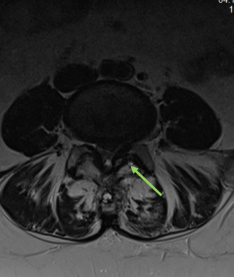 Spinalkanalstenose-transversal