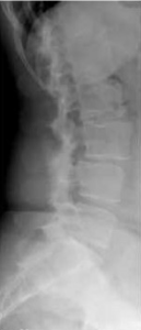 Spondylodese-2