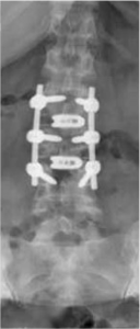 Spondylodese-3