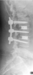 Spondylodese-4